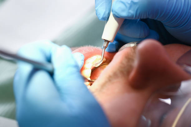 Best Emergency Wisdom Teeth Removal in Maple Bluff, WI